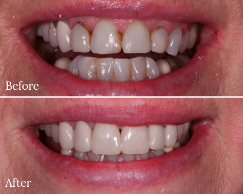 A before and after smile makeover by our dentist in Charlotte, NC