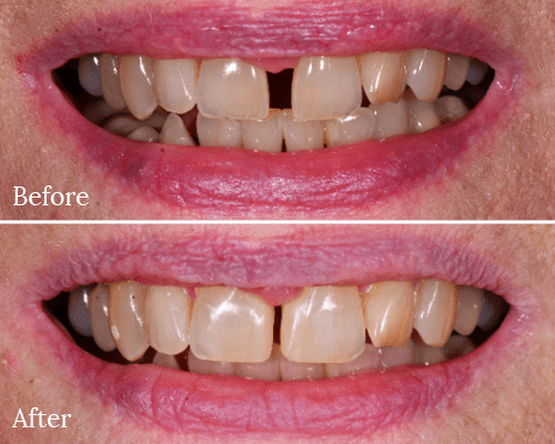 A before and after smile makeover by our dentist in Charlotte, NC